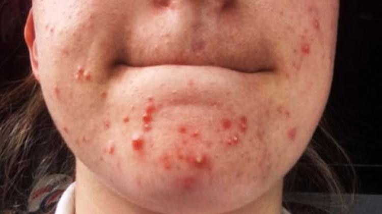 Popüler sivilce ilacı öldürüyordu!