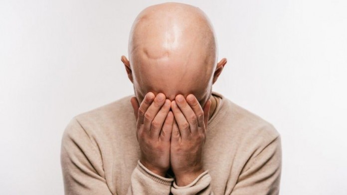 covid-19-ile-kellik-arasinda-baglanti-16774